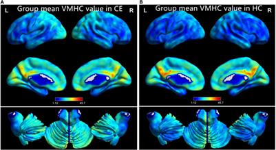 Altered Homotopic Connectivity in the Cerebellum Predicts Stereopsis Dysfunction in Patients With Comitant Exotropia